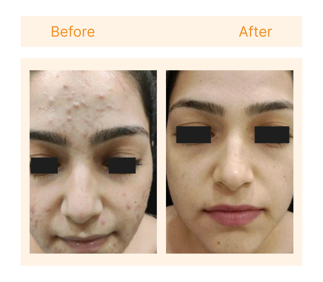 Before and after at Skin Plus Luxe New Delhi
