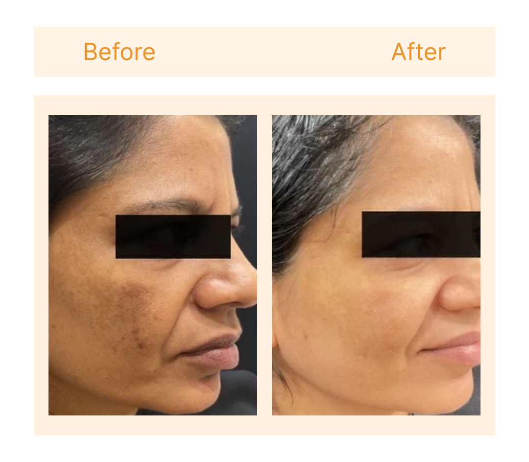 Before and after at Skin Plus Luxe New Delhi