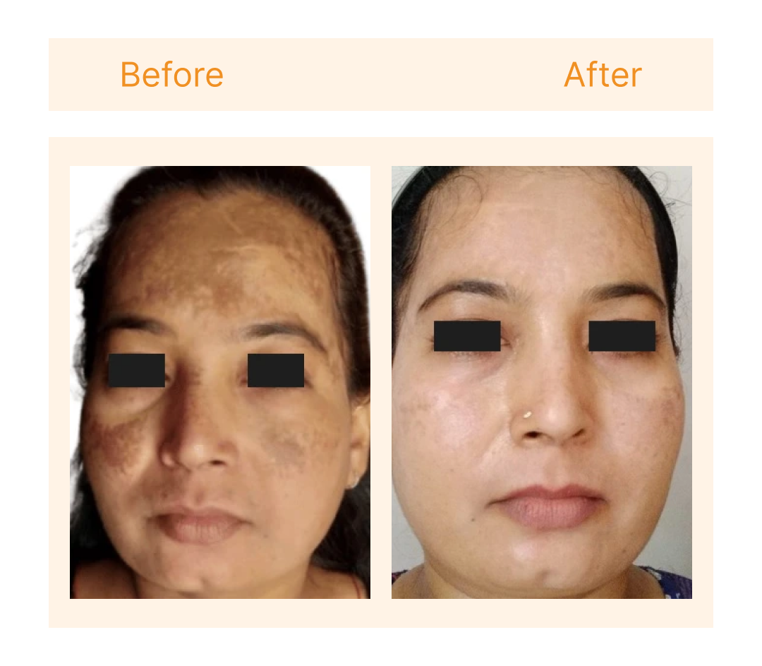 Before and after at Skin Plus Luxe New Delhi